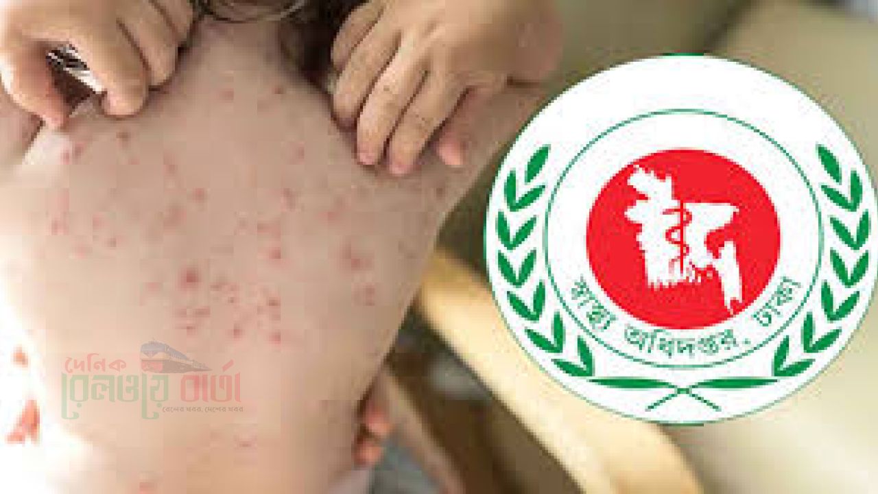 একমাসে হাম ও হাম সন্দেহে ১৯৮ শিশুর মৃত্যু